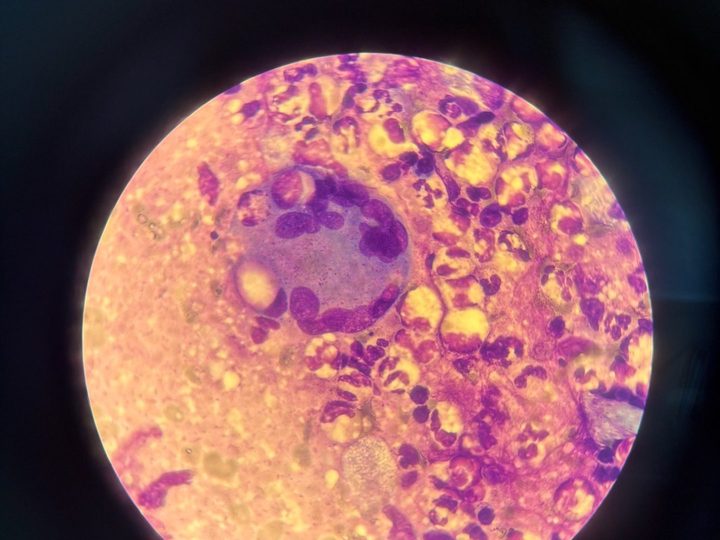 Lymph node imprint: Pirogov-Langhans giant multinucleated cell