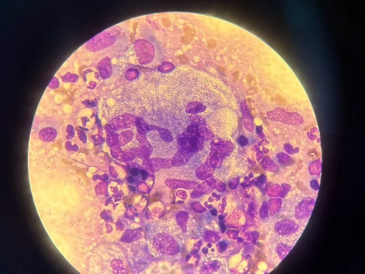 Cervical lymph node imprint: large multinucleated cell and neutrophils