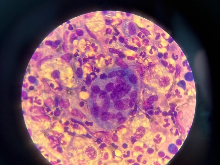 Lymph node imprint: multinucleated cell with characteristic nuclear arrangement