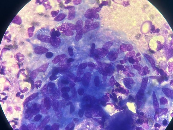 Lymph node imprint: syncytium of epithelioid cells with elongated nuclei