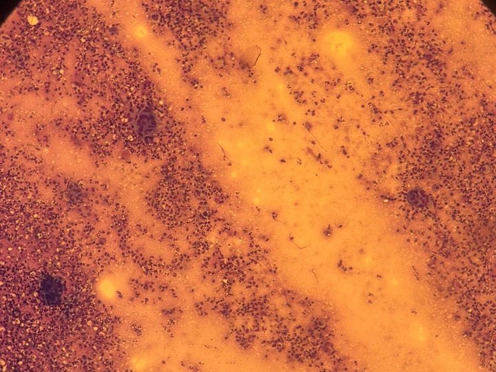 Lymph node imprint at low magnification: hypercellularity and areas of necrosis
