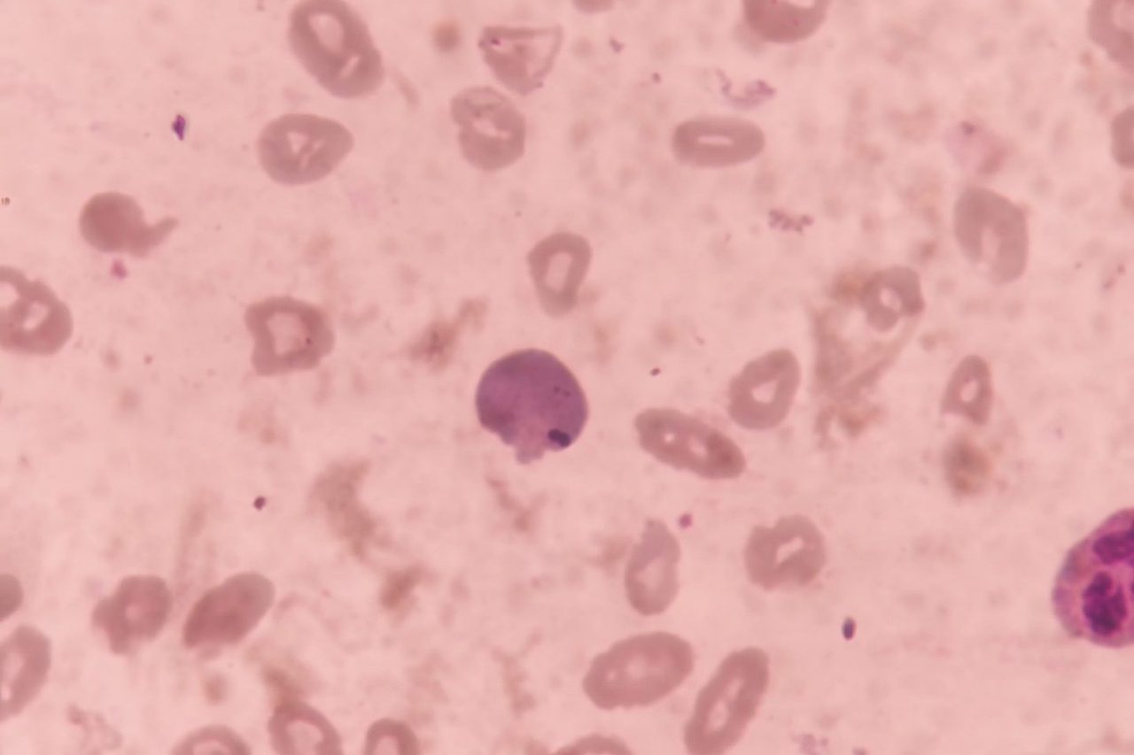Severe Anemia: Erythrocyte Morphology in Blood Smear
