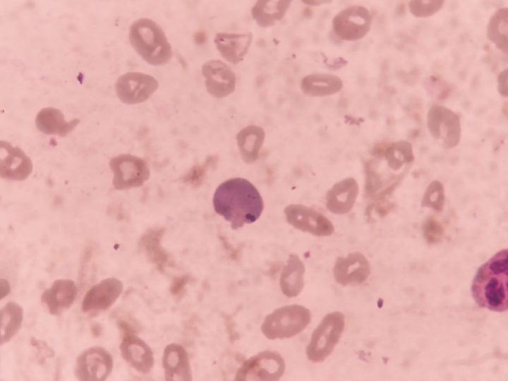 Blood smear: Howell-Jolly body in an erythrocyte and marked hypochromia