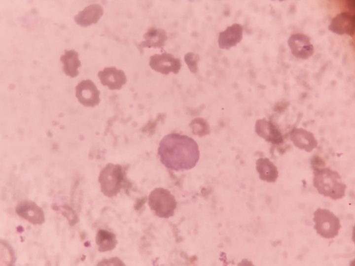 Blood smear: polychromatophil and marked hypochromia of erythrocytes