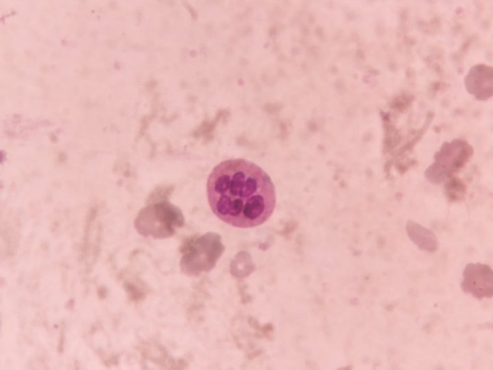 Blood smear: hypersegmented neutrophil against the background of anemia