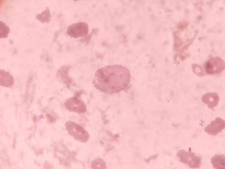 Blood smear: large erythrocyte with basophilic granulation