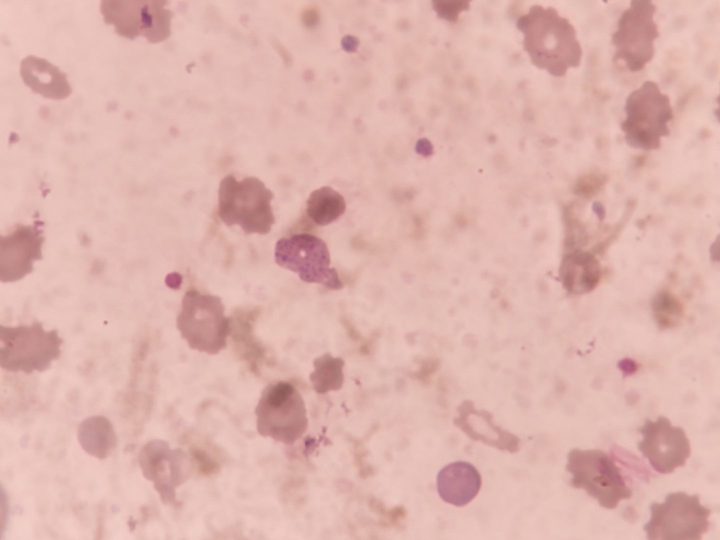Blood smear: Howell-Jolly body-like inclusion and poikilocytosis