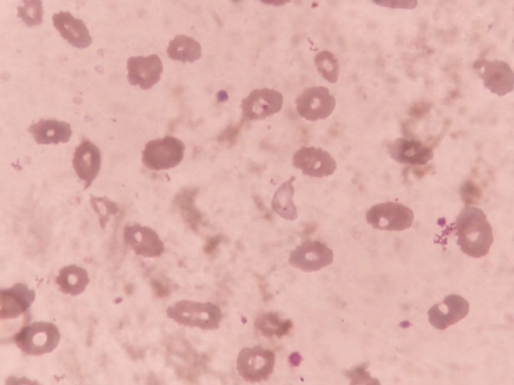 Blood smear: annulocytes, marked anisocytosis and poikilocytosis