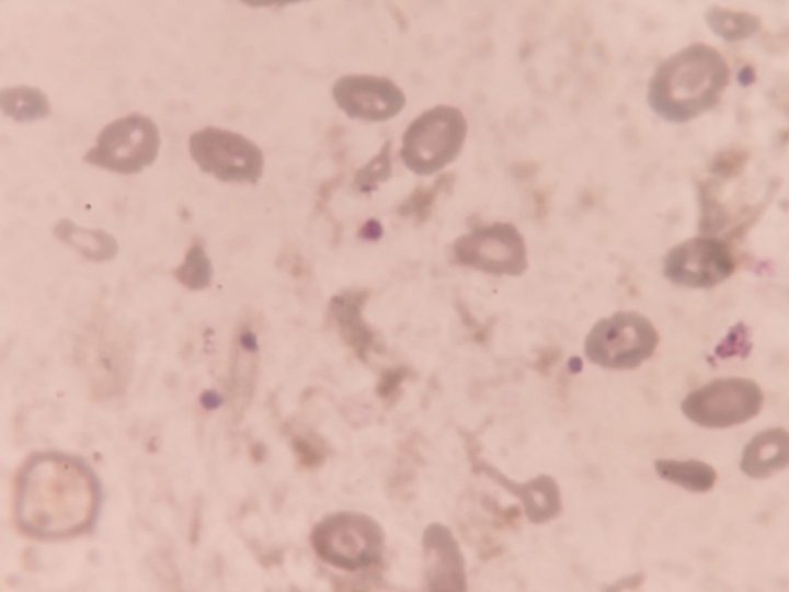Blood smear: severe hypochromia of erythrocytes and small inclusions