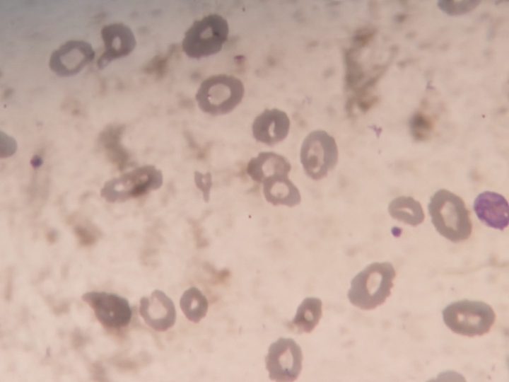 Blood smear: marked hypochromia and erythrocyte with granulation