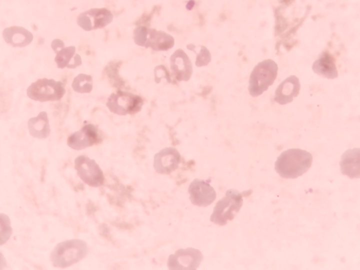 Blood smear: severe hypochromia and poikilocytosis of erythrocytes