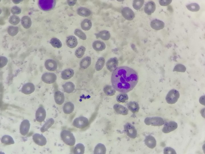 Blood smear: marked aniso-poikilocytosis of erythrocytes and a segmented neutrophil