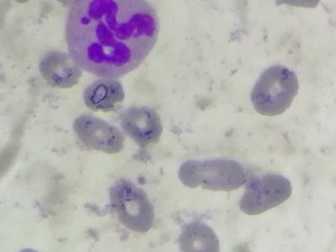 Blood smear: segmented neutrophil with a characteristic Barr body near the nucleus