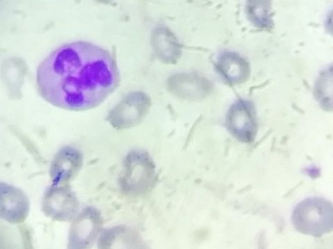 Blood smear: neutrophil and erythrocyte poikilocytosis at high magnification