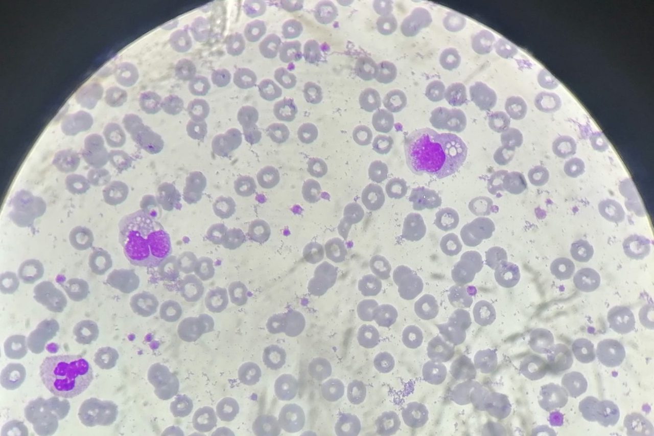 Monocyte Vacuolization in Peripheral Blood Smears