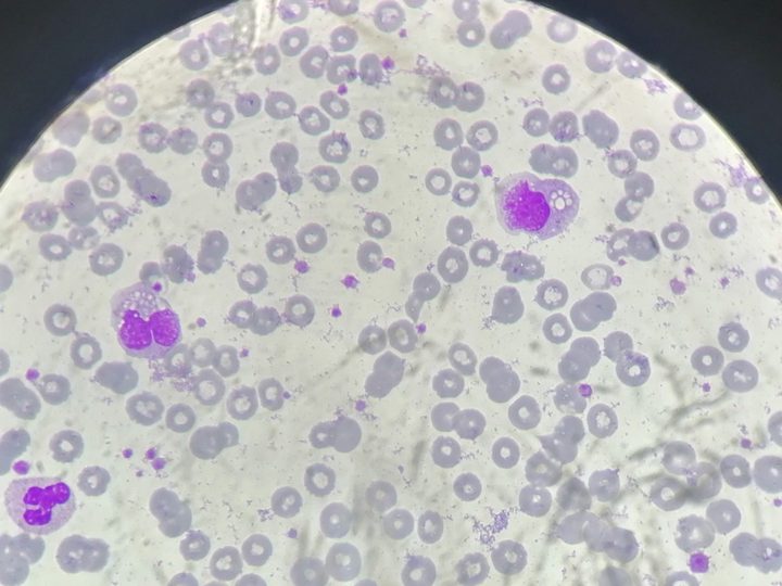 Blood smear: monocytes with cytoplasmic vacuolization and a neutrophil in the field of view