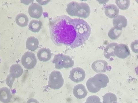 Blood smear: monocyte with multiple vacuoles in the cytoplasm