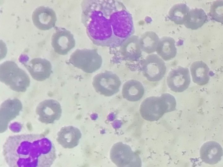 Blood smear: vacuolated monocyte and a segmented neutrophil