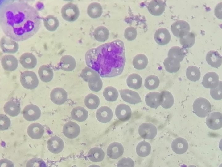 Blood smear: monocyte with toxic cytoplasmic vacuolization