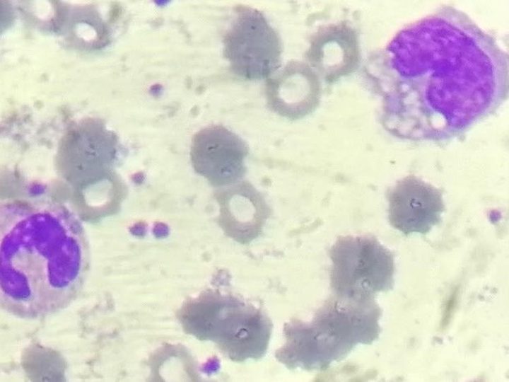 Blood smear: monocyte with vacuoles next to a band neutrophil