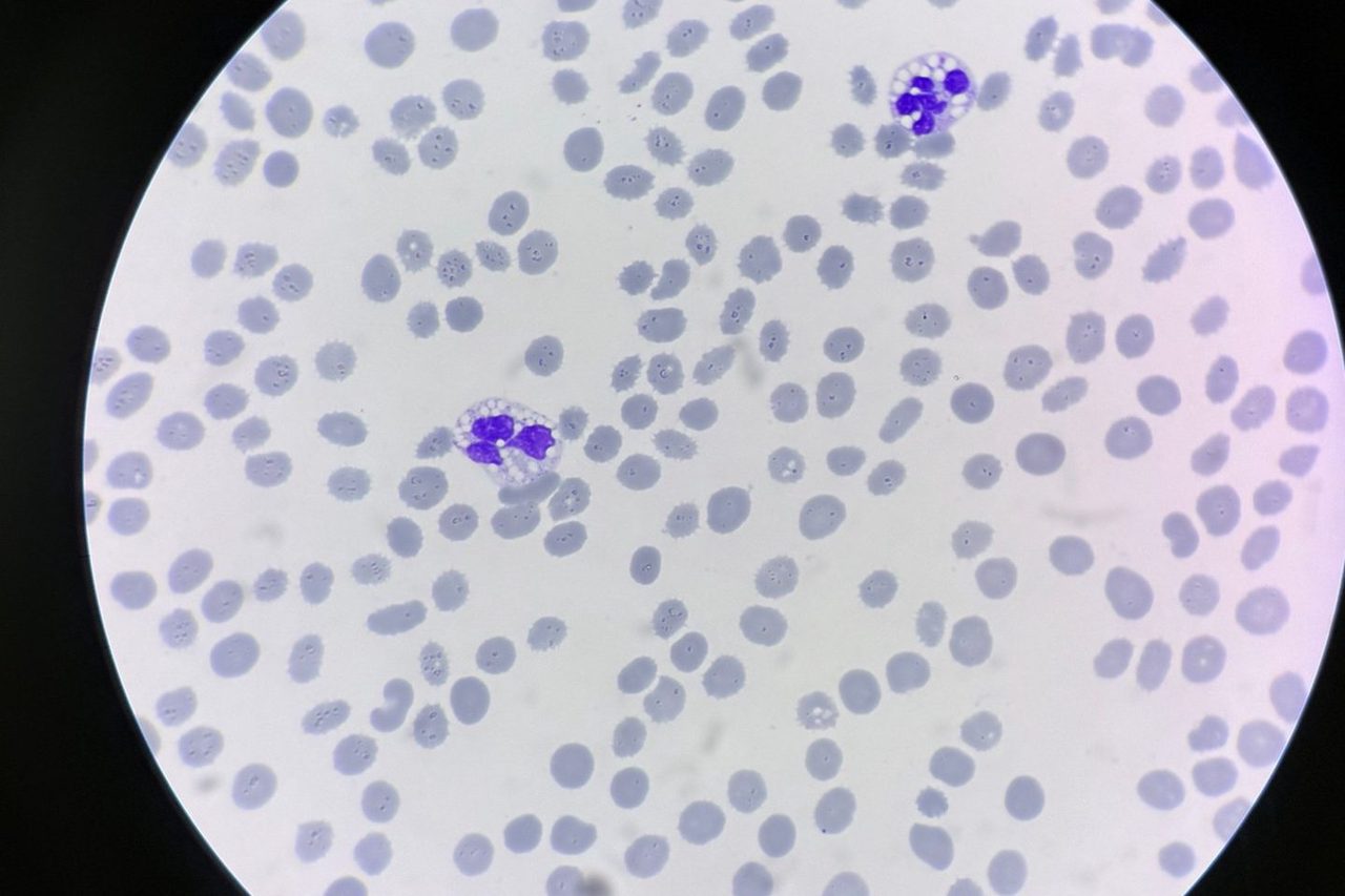 Neutrophil Vacuolization in Peripheral Blood Smear