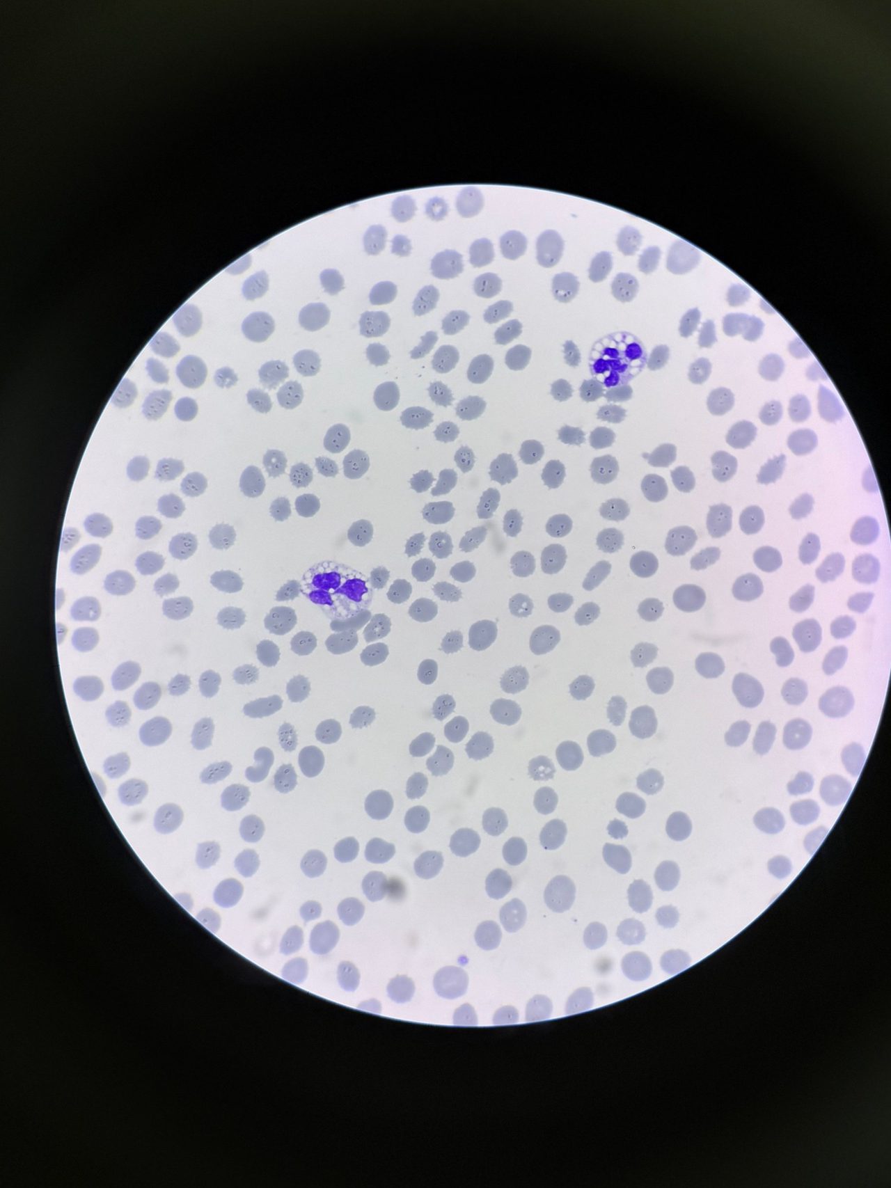 Blood smear: segmented neutrophils with marked cytoplasmic vacuolization