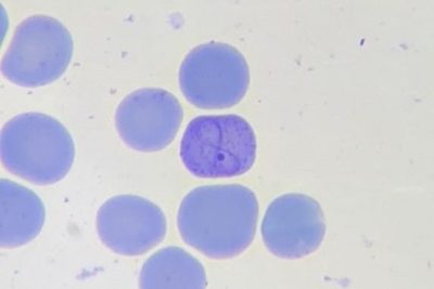 Erythrocyte Inclusions: Cabot Rings & Howell-Jolly Bodies
