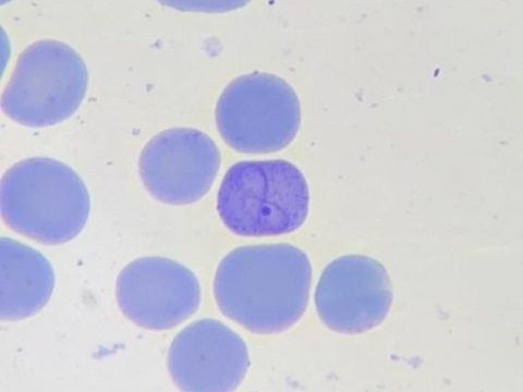 Blood smear: polychromatophil with Cabot ring and fine basophilic stippling