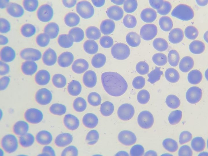 Blood smear: Cabot ring in a large oval erythrocyte with anisopoikilocytosis