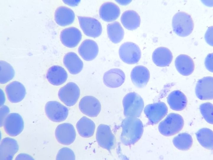Blood smear: filamentous Cabot ring in an erythrocyte with poikilocytosis