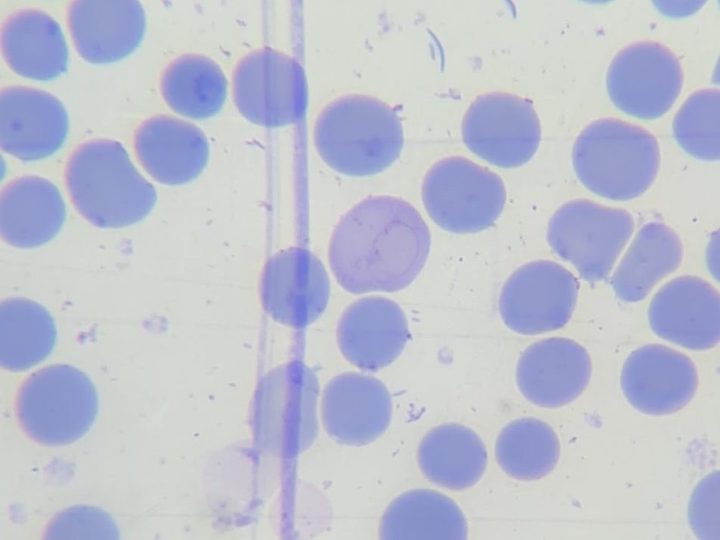 Blood smear: Cabot ring in a macrocyte surrounded by normocytes