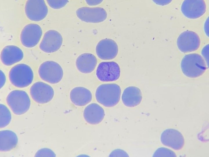 Blood smear: detailed microscopy of an erythrocyte with a Cabot ring and inclusions