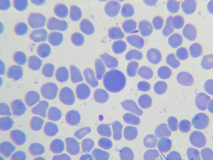 Blood smear: large hyperchromic macrocyte and pronounced anisopoikilocytosis
