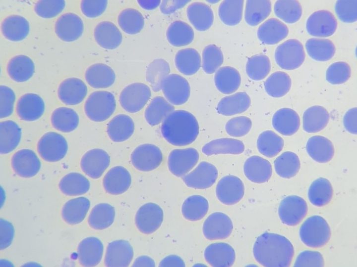 Blood smear: macrocyte and poikilocytes in peripheral blood examination