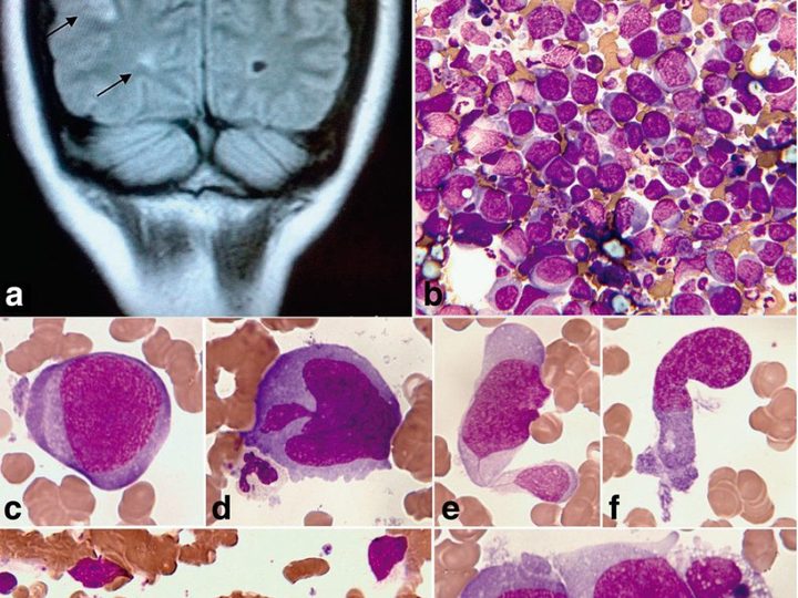 Brain MRI and bone marrow smear: atypical lymphoma cells