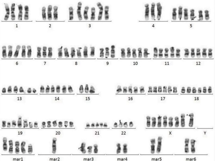 Karyogram: multiple complex chromosomal rearrangements