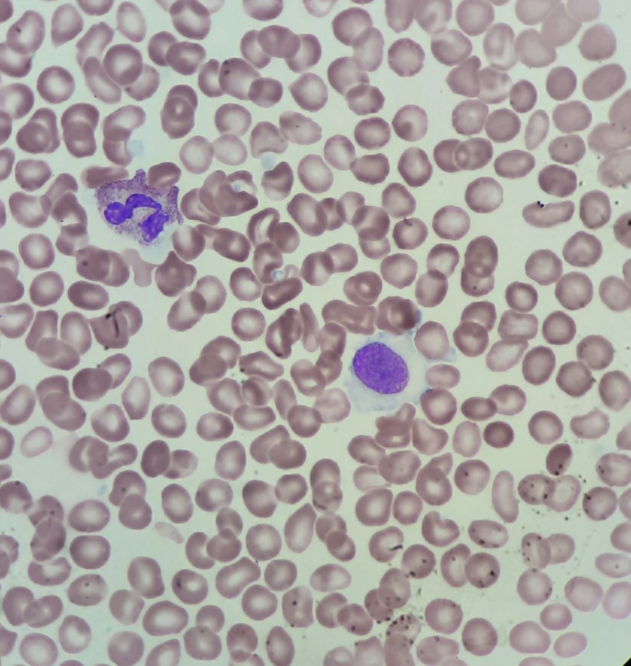 Hairy Cell Leukemia: Morphology and Flow Cytometry