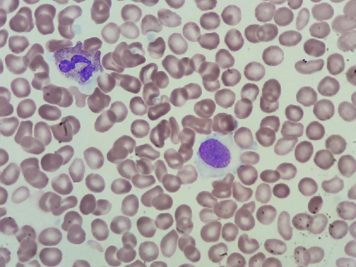 Peripheral blood smear: hairy cell leukemia cell with irregular pale cytoplasm