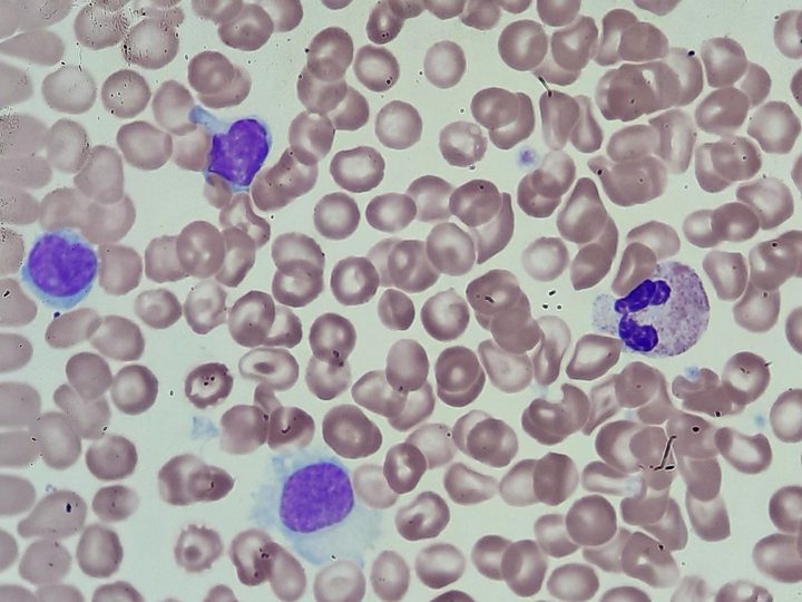 Blood smear: HCL cell with characteristic villous cytoplasmic border next to a neutrophil