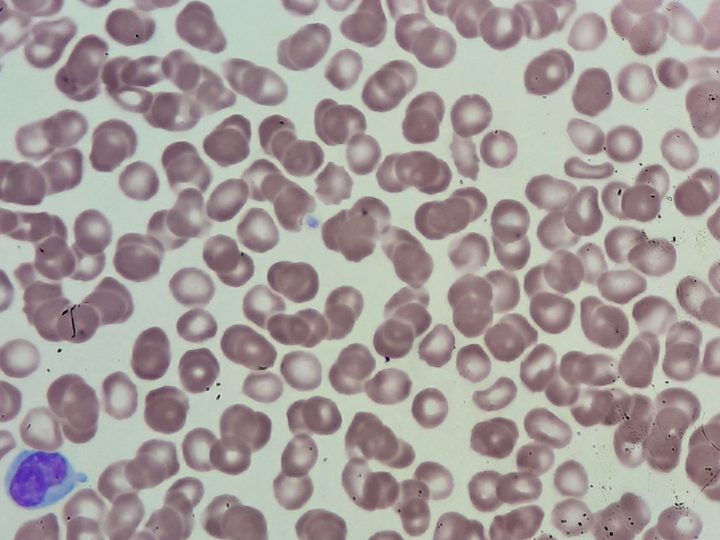 Peripheral blood smear: lymphoid elements with irregular cytoplasmic contours