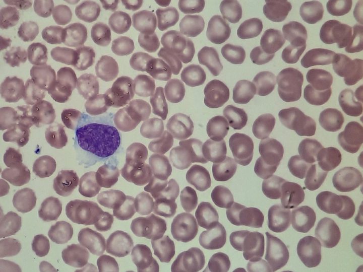 Blood smear: typical hairy cell leukemia cell with an oval nucleus