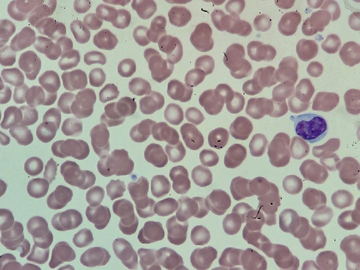Peripheral blood smear: single HCL cells with reniform nuclei and cytoplasmic projections