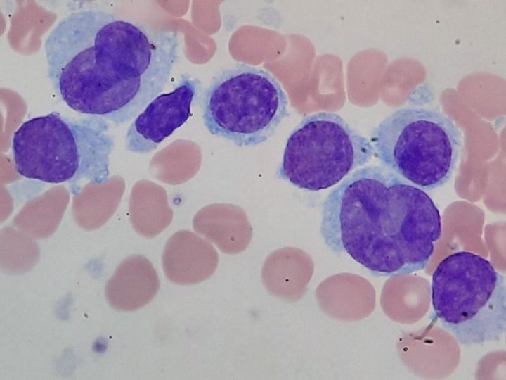 Bone marrow smear: cluster of HCL tumor cells with abundant clear cytoplasm