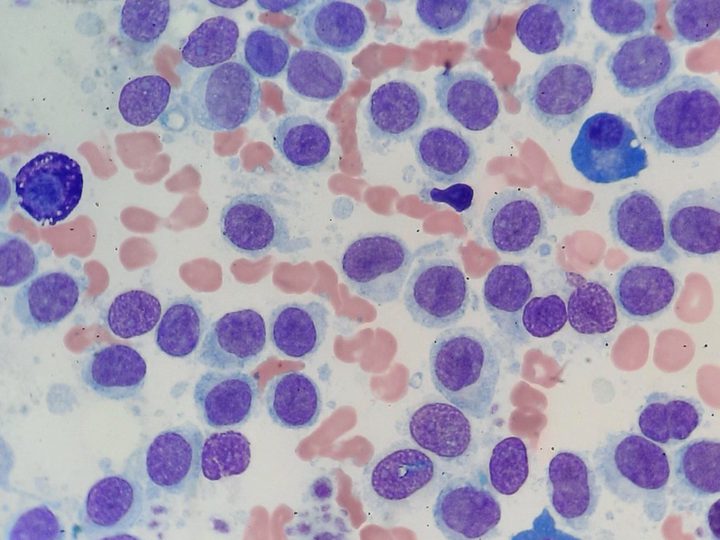 Bone marrow smear: subtotal infiltration by monomorphic HCL cells