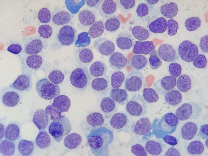 Bone marrow smear: diffuse replacement of hematopoiesis by HCL tumor elements
