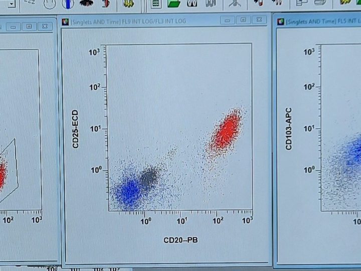 Flow cytometry: co-expression of CD20, CD25, CD11c, and CD103 on neoplastic B-lymphocytes