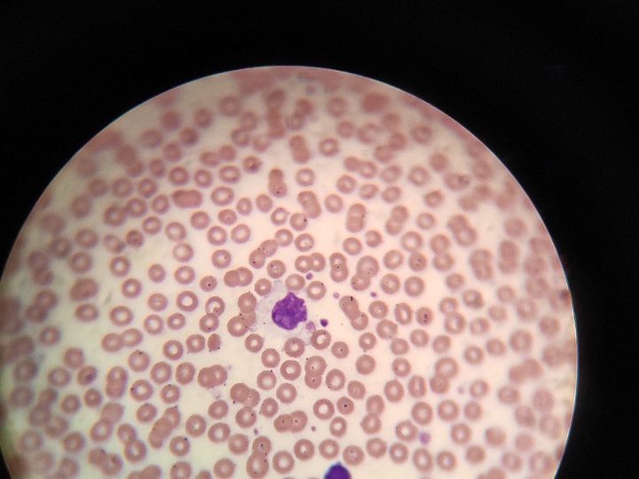 Мазок крови: волосатая клетка с характерным фестончатым краем цитоплазмы