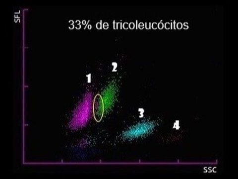 Скаттерограмма анализатора: область трихолейкоцитов между моноцитами и лимфоцитами