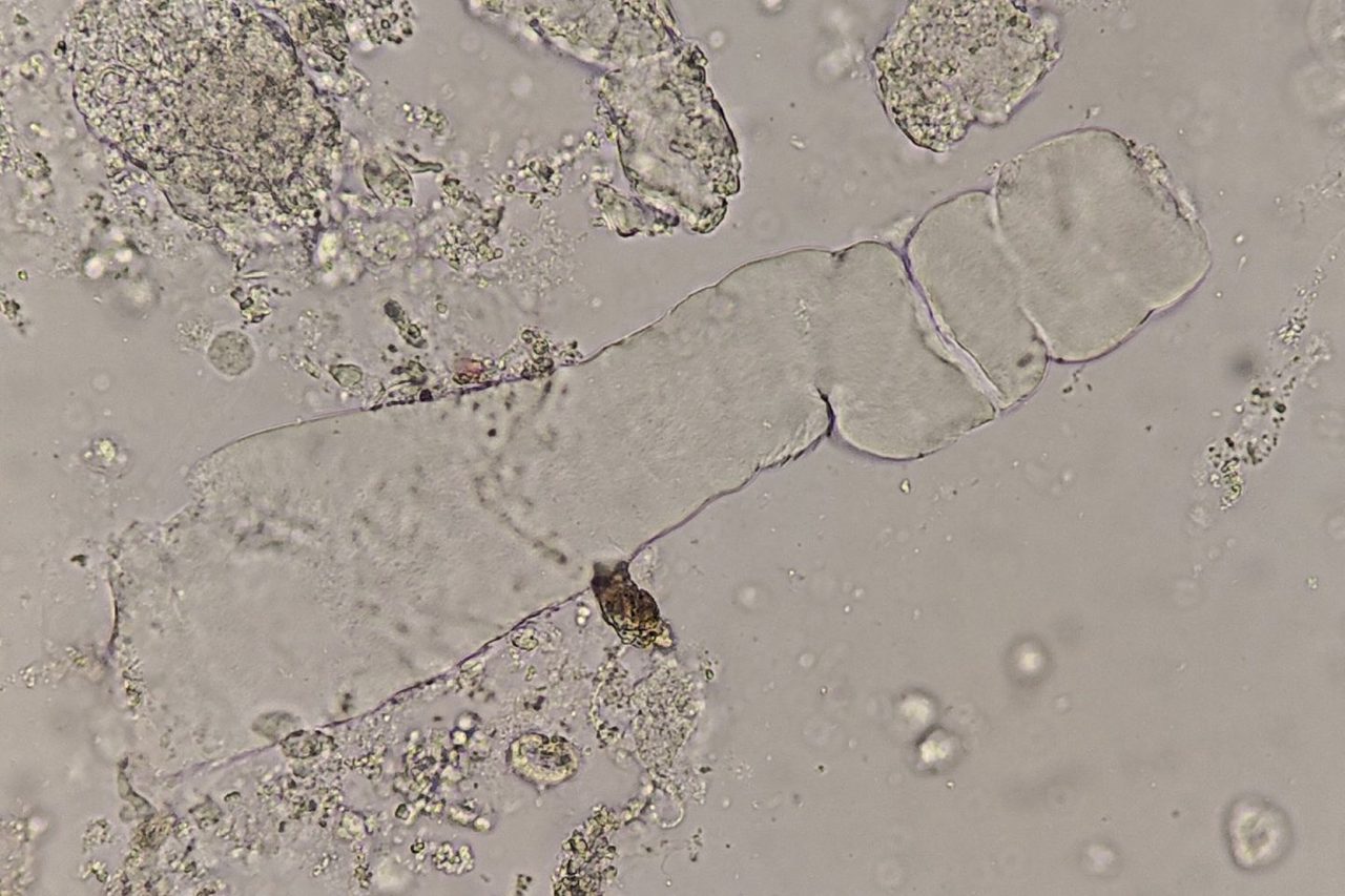 Waxy Casts in Urine Sediment Microscopy: Morphology & Diagnosis