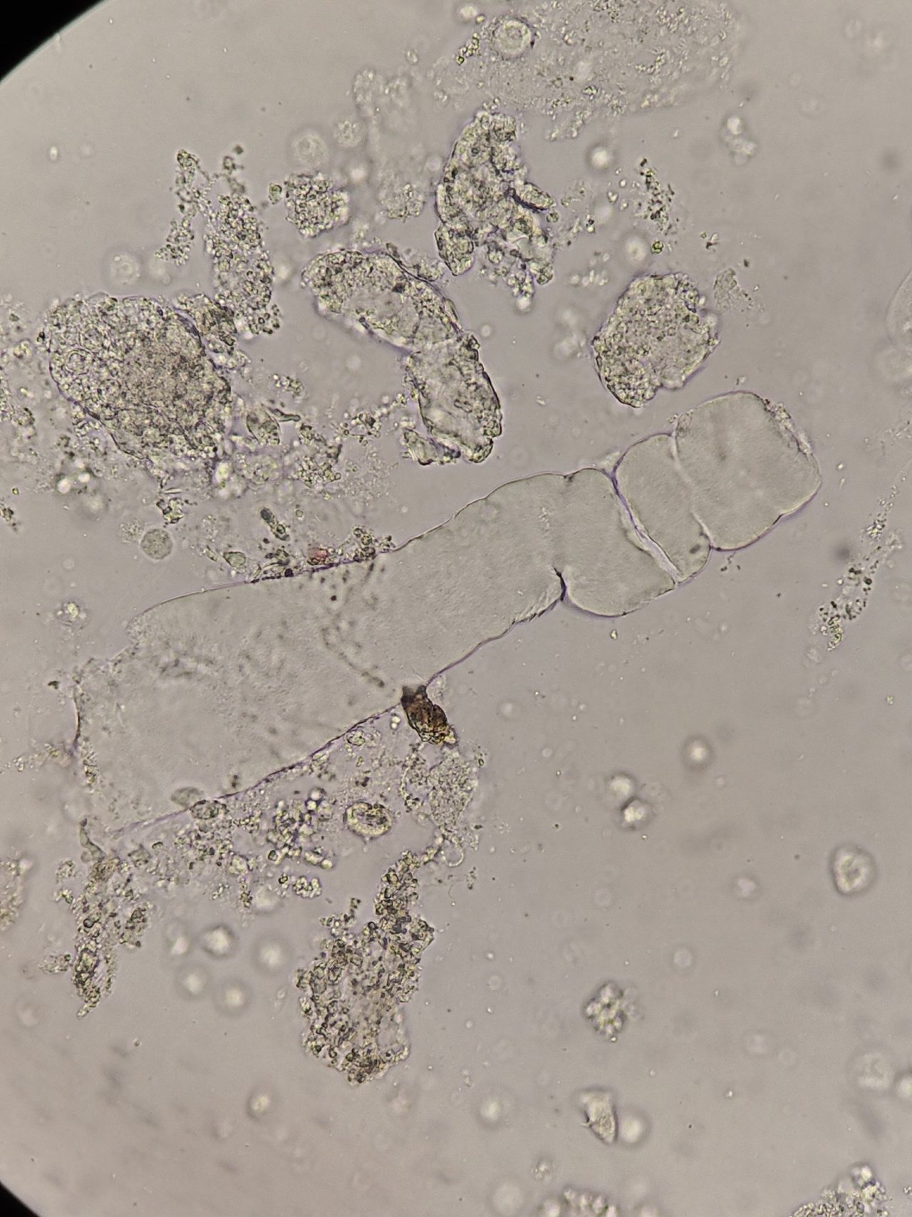 Waxy Casts in Urine Sediment Microscopy: Morphology & Diagnosis